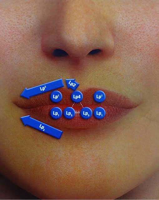 Lipvergroting (lipopvulling)