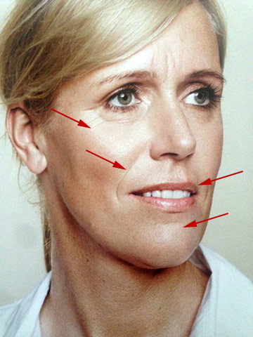 Young and Beautiful Liquid Facelift